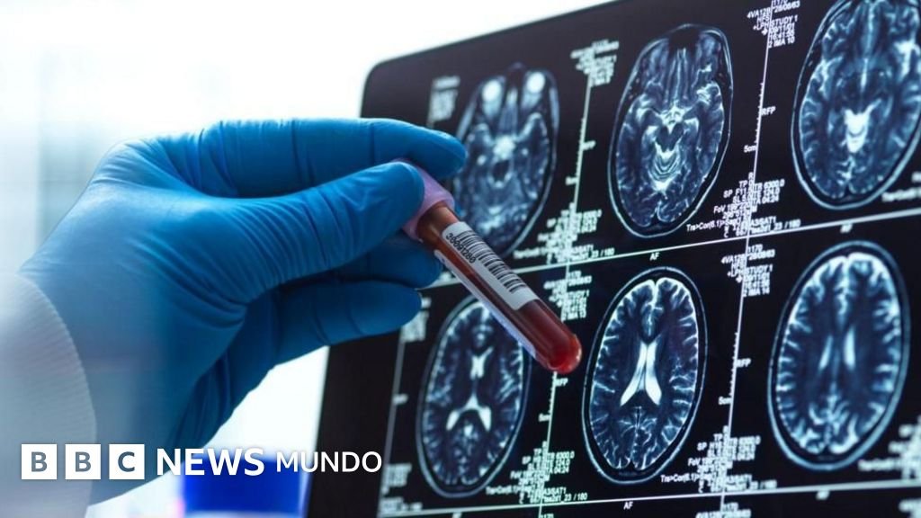 Cuatro avances prometedores en la lucha contra el Alzheimer este año