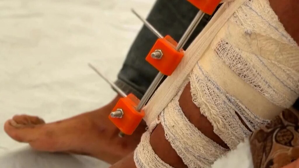 Médicos de Gaza crean dispositivos impresos en 3D para salvar a pacientes de la amputación